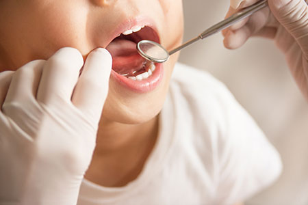 乳歯のむし歯を放置することのリスク