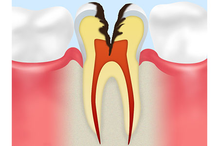 歯の神経まで達した虫歯